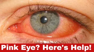 Become Pink Eye-Free Fast: Learn How to Get Rid of Pink Eye Fast!