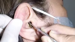 Removing Woman's Big Black Earwax | Ear is Clogged!