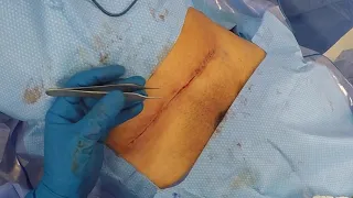 How to suture like a plastic surgeon: Lesson 8 - Running subcuticular suture