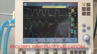 Introduction to Mechanical Ventilation Part 1: Dr. Richard Savel