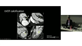 Computed Tomography for TAVI - Dr James Otton