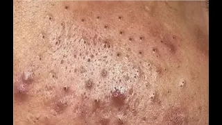 Satisfying And Relaxation with NaSa Beauty Spa #27 blackhead and acne extraction