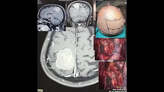 POST FALX MENINGIOMA -CORTCAL VEINS PRESERVATION-  MICROSURGERY -dr suresh dugani/HUBBALLI/INDIA