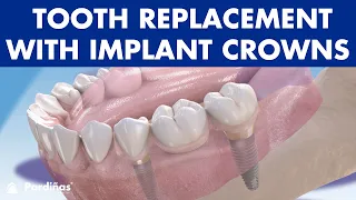 MISSING TEETH? Four solutions for TOOTH REPLACEMENT with IMPLANT CROWNS ©