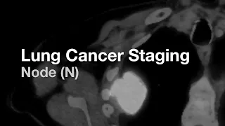 Lung Cancer Staging - Node (N)