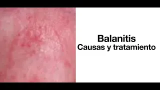 Balanitis: Causas y tratamiento - Cura de la balanitis