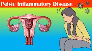 Pelvic Inflammatory Disease (PID) - Causes, Signs & Symptoms, Diagnosis, And Treatment