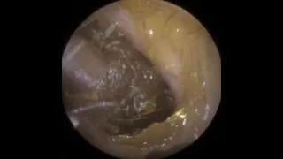 839 - Very Sticky Occluding Ear Wax Removal