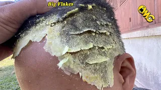 DRY SCALP !! Big Flakes Dandruff Scratching Satisfying Video #960