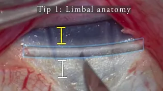 AIOC2018 - VT277 - Pointers to Schlemm’s Canal