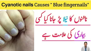 Bluish-Purple Discoloration Of Nails | Cyanotic Nails | ناخن کا رنگ نیلا پڑنے کی وجہ اور علاج |