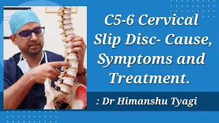 C5  - C6  Cervical Slip Disc- Cause, Symptoms and Treatment.