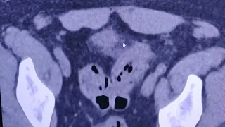 Incidental and unexpected findings in Radiology
