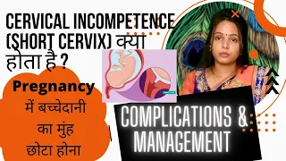 What is Cervical incompetence ( Short cervix) ? Treatment, complications & management.