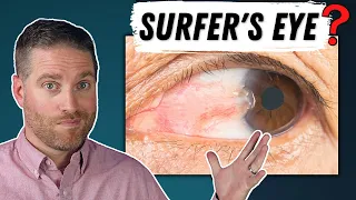Surfer's Eye - Pterygium Explained (Growth On Your Eye)