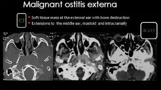 Imaging of Petrous bone pathology Sep 2013   Dr Mamdouh Mahfouz In Arabic