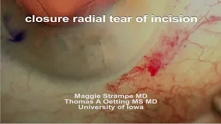 X suture for radial tear