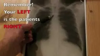 How to interpret a Chest Xray in under 4 minutes