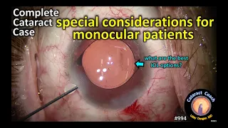 special considerations for monocular patients having cataract surgery