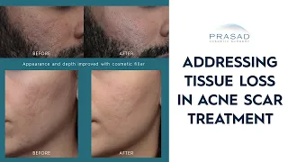 Why Addressing Tissue Loss is Important in Acne Scar Treatment