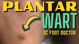 Plantar Wart (Verruca Plantaris)