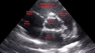 Parasternal Short Axis View Aortic Level - Loop