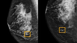 AI model improves breast cancer detection on mammograms