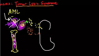 Oncologic Emergencies: Tumor Lysis Syndrome