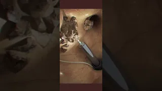 Kidney Stone Surgery Using Laser.