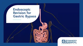 Endoscopic Revision for Gastric Bypass 3D Animation