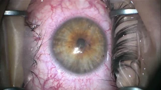 Corneal Laceration repair