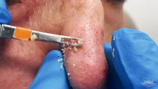 Nose Blackheads Extracted | CONTOUR DERMATOLOGY