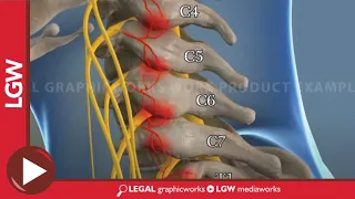 Cervical Radio Frequency Ablation animated surgery recreation