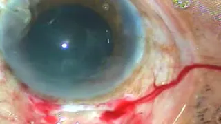 Best video for Teaching manual SICS to the beginners of Cataract Surgery