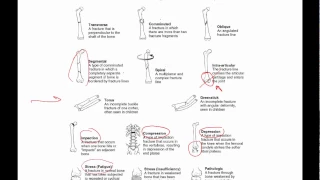 General principles of ortho trauma for PA students 1 - basics