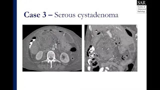 Solid and cystic pancreatic lesion