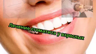 Лечение стоматита у взрослых