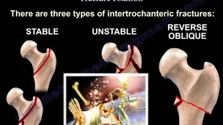 Intertrochanteric Hip Fractures - Everything You Need To Know - Dr. Nabil Ebraheim