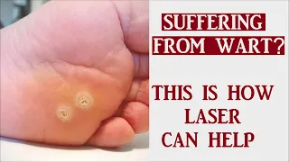 what are Warts?  | Wart Treatment At Skinaa Clinic