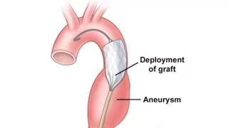The Changing Treatment of Thoracic Aortic Aneurysms