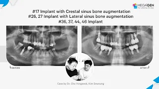 Dr. Yongseok CHO, Sewoung KIM, #17 CSBA, #26, 27 LSBA,#36, 37, 44, 46 implant surgery and prosthesis