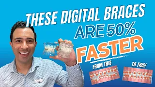Custom Digital Braces Case Review - 50% FASTER braces!