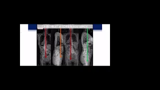 The Ideal Case for MIS Anterior/Posterior Approaches