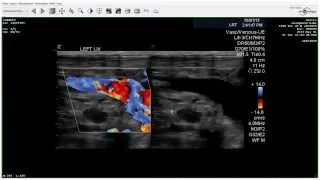 Positive Upper Extremity Venous Duplex - Case Study