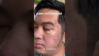 Laser co2 fractional lagii 😁