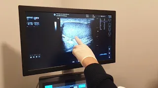 Control Examination on the 1st month after Microsurgery Varicocele Operation with Istanbul Technique