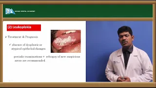 White lesions of oral cavity