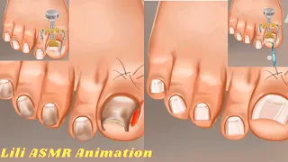 ASMR Satisfying! athlete's foot toenail treatment animation | 내성발톱 | Lili ASMR Animation