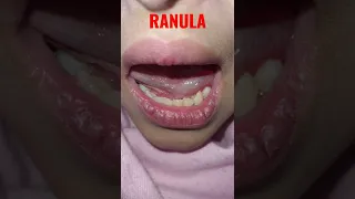 RANULA IN THE FLOOR OF MOUTH,