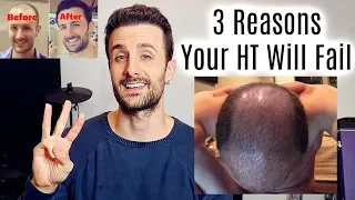 3 Reasons Your Hair Transplant Will FAIL